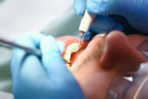 Best Emergency Wisdom Tooth Extraction in Quinnipiac University, CT